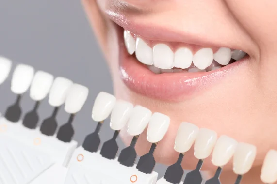 Clareamento Dentário